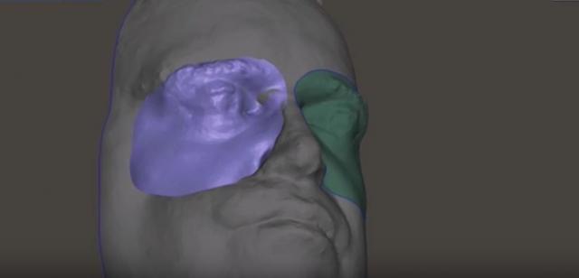 Pacijent dobio prvu 3D štampanu protezu lica (VIDEO)
